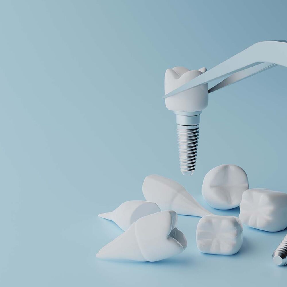 shutterstock-1547733968-dental-implant-01